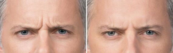 Botox Before and After Photos in Boston, MA, Patient 2602