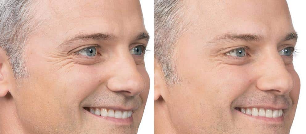 Patient 2602, Botox Before and After Photos Botox Before and After Photos in Boston, MA, Patient 2602