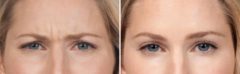 Botox Before and After Photos in Boston, MA, Patient 2607