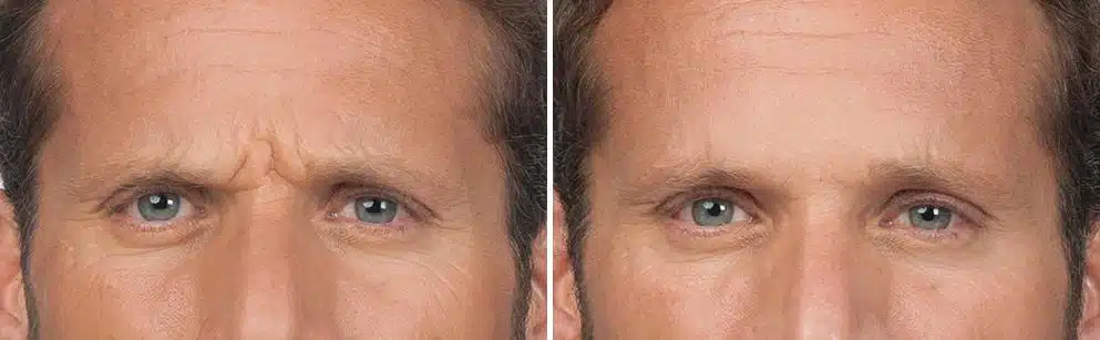 Botox Before and After Photos in Boston, MA, Patient 2612