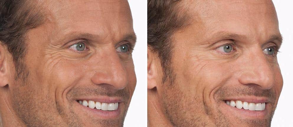 Patient 2612, Botox Before and After Photos Botox Before and After Photos in Boston, MA, Patient 2612