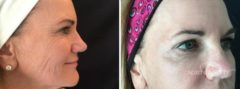 Botox Before and After Photos in Boston, MA, Patient 2576