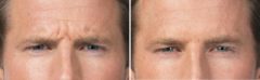 Botox Before and After Photos in Boston, MA, Patient 2582