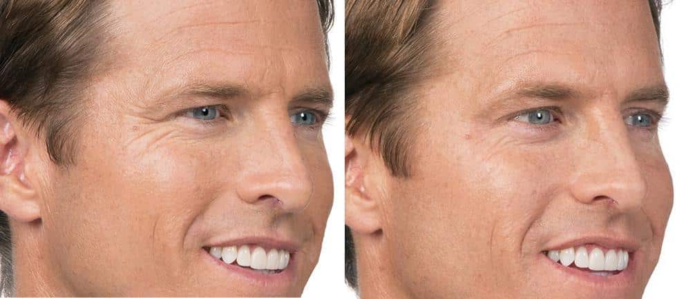 Patient 2582, Botox Before and After Photos Botox Before and After Photos in Boston, MA, Patient 2582
