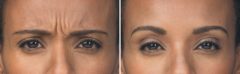 Botox Before and After Photos in Boston, MA, Patient 2587