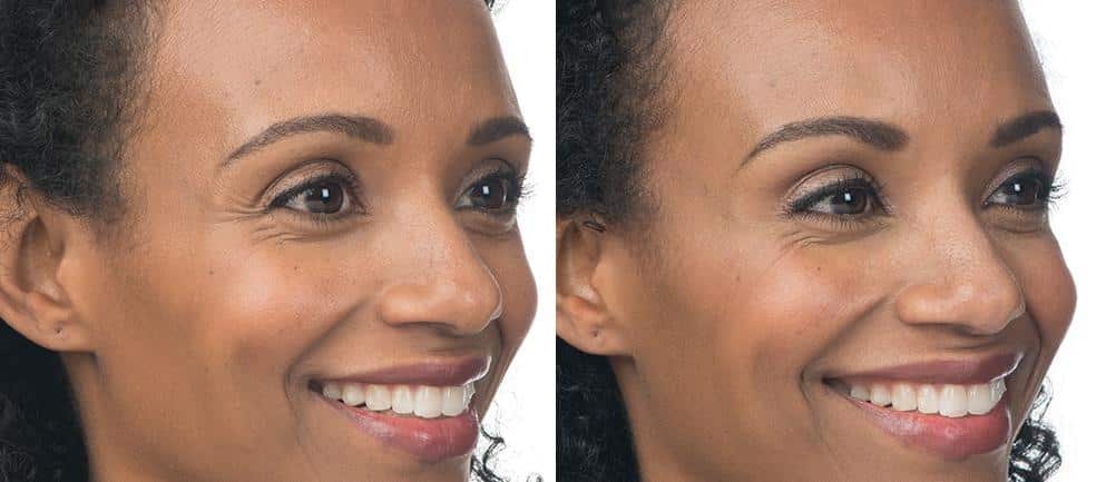 Patient 2587, Botox Before and After Photos Botox Before and After Photos in Boston, MA, Patient 2587