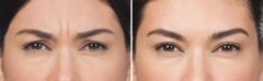 Botox Before and After Photos in Boston, MA, Patient 2592