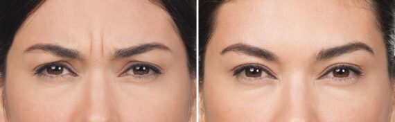 Botox Before and After Photos in Boston, MA, Patient 2592