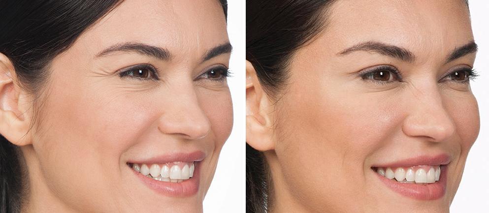 Patient 2592, Botox Before and After Photos Botox Before and After Photos in Boston, MA, Patient 2592