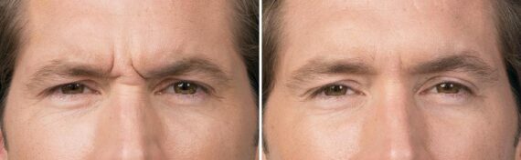 Botox Before and After Photos in Boston, MA, Patient 2597