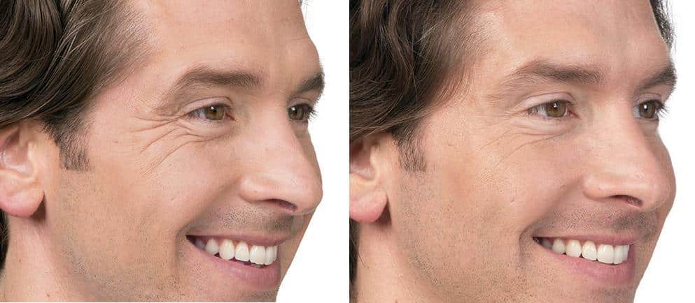 Patient 2597, Botox Before and After Photos Botox Before and After Photos in Boston, MA, Patient 2597