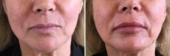 Lip Augmentation Before and After Photos in Boston, MA, Patient 3920