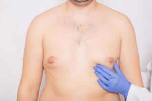 What is the Best Treatment Option for Your Gynecomastia?