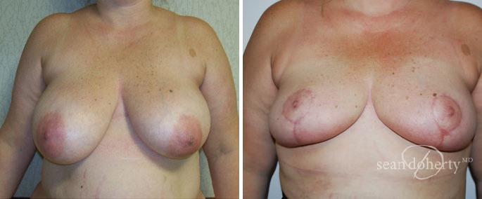 Breast Reduction Before and After Photos in Boston, MA, Patient 3222