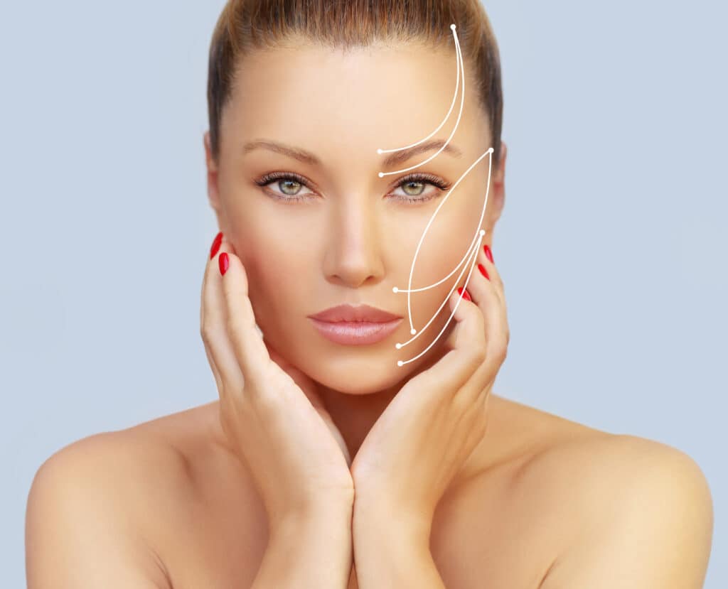 Thread Lift Delivers Immediate Results