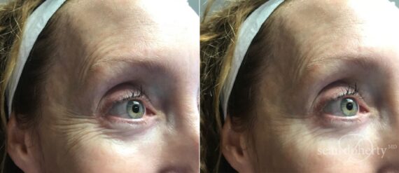 Botox Before and After Photos in Boston, MA, Patient 4074