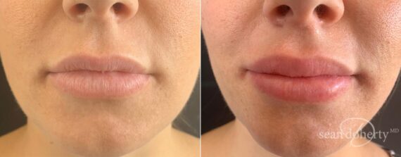 Lip Augmentation Before and After Photos in Boston, MA, Patient 4060