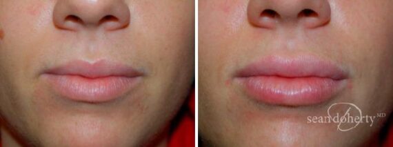 Lip Augmentation Before and After Photos in Boston, MA