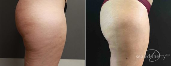 Liposuction Before and After Photos in Boston, MA, Patient 4169