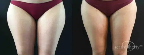 Liposuction Before and After Photos in Boston, MA, Patient 4169