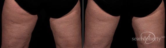 TempSure Before and After Photos in Boston, MA, Patient 4284