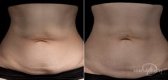 TempSure Before and After Photos in Boston, MA, Patient 4297