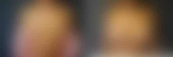 Breast Augmentation Before and After Photos in Boston, MA, Patient 2390