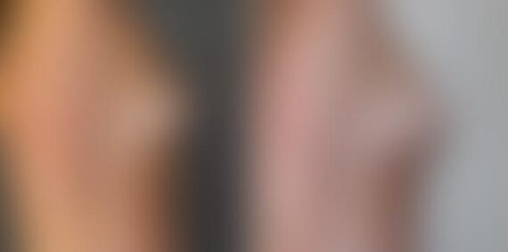 Breast Augmentation Before and After Photos in Boston, MA, Patient 3268