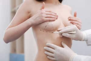 How to Prepare for Your Breast Augmentation Consultation