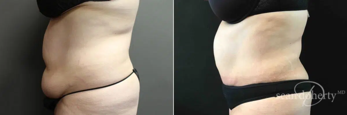 Liposuction Before and After Photos in Boston, MA, Patient 5057