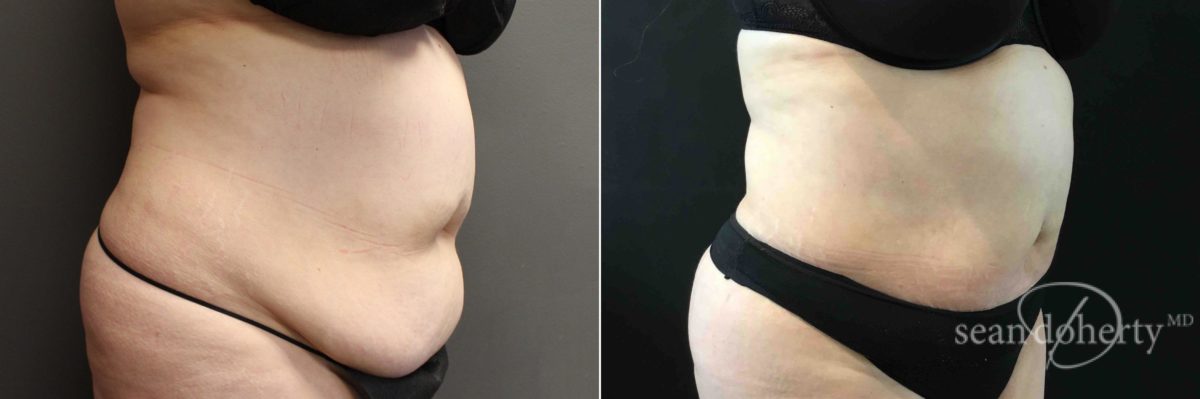 Liposuction Before and After Photos in Boston, MA, Patient 5057