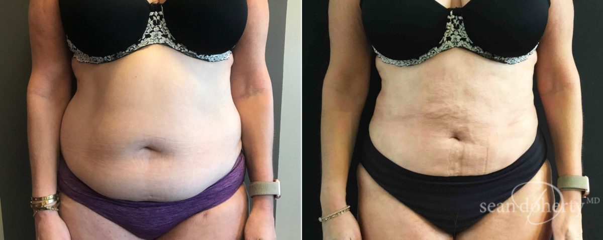 Patient 5067, Liposuction Before and After Photos Liposuction Before and After Photos in Boston, MA, Patient 5067