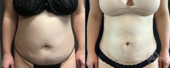 Liposuction Before and After Photos in Boston, MA, Patient 5071