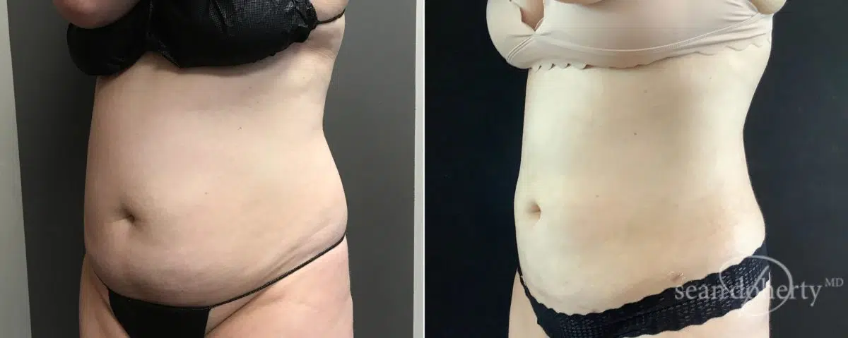 Liposuction Before and After Photos in Boston, MA, Patient 5071