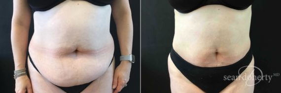 Liposuction Before and After Photos in Boston, MA, Patient 5057