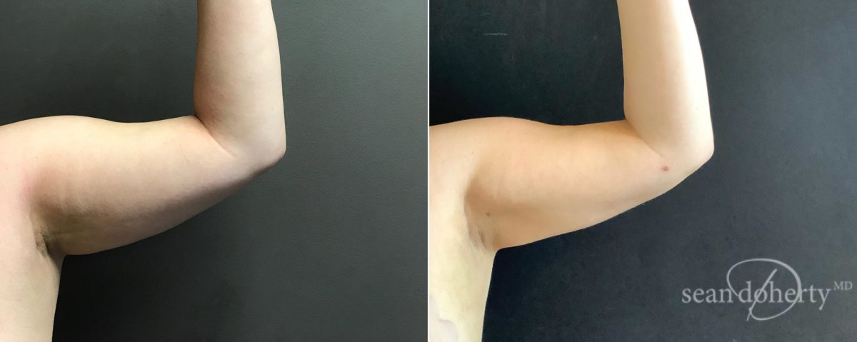 Liposuction Before and After Photos in Boston, MA, Patient 5071