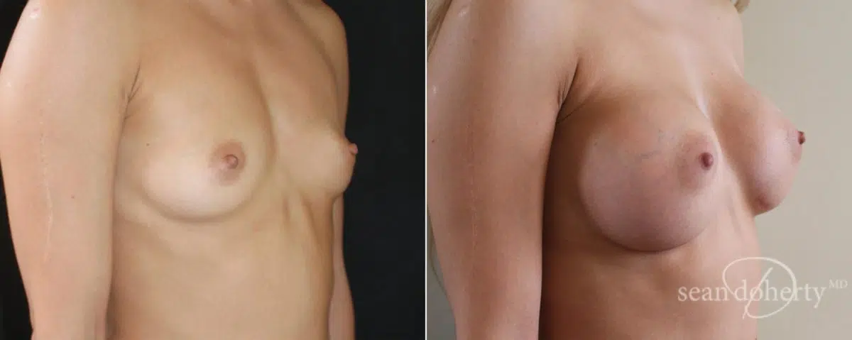 Breast Augmentation Before and After Photos in Boston, MA, Patient 4681