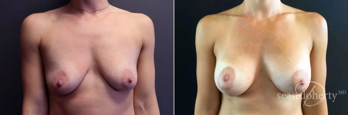 Breast Lift with Implants Before and After Photos in Boston, MA, Patient 5011