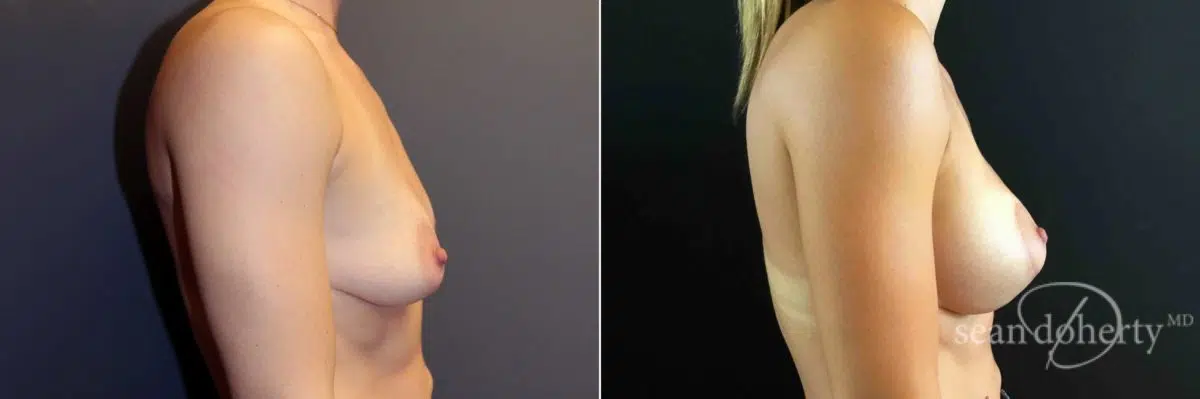 Breast Lift with Implants Before and After Photos in Boston, MA, Patient 5011