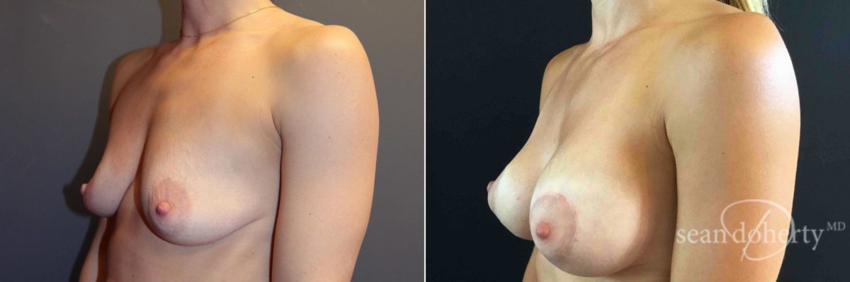 Breast Lift with Implants Before and After Photos in Boston, MA, Patient 5011