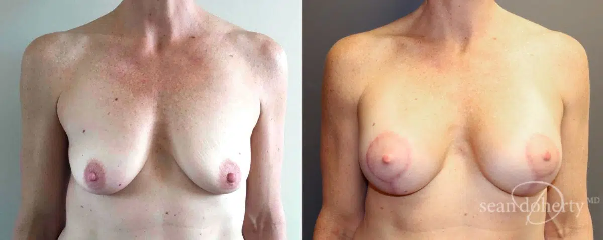 Patient 5100, Breast Lift with Implants Before and After Photos Breast Lift with Implants Before and After Photos in Boston, MA, Patient 5100