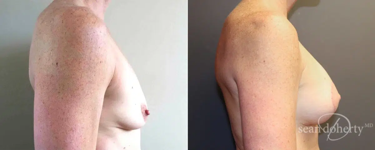 Breast Lift with Implants Before and After Photos in Boston, MA, Patient 5100