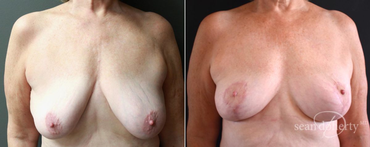 Breast Lift Before and After Photos in Boston, MA, Patient 5130