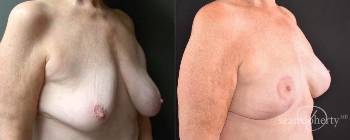 Breast Lift Before and After Photos in Boston, MA, Patient 5130