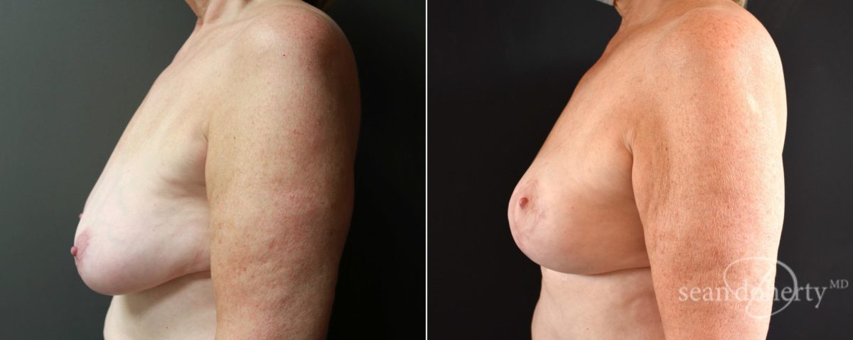 Patient 5130, Breast Lift Before and After Photos Breast Lift Before and After Photos in Boston, MA, Patient 5130