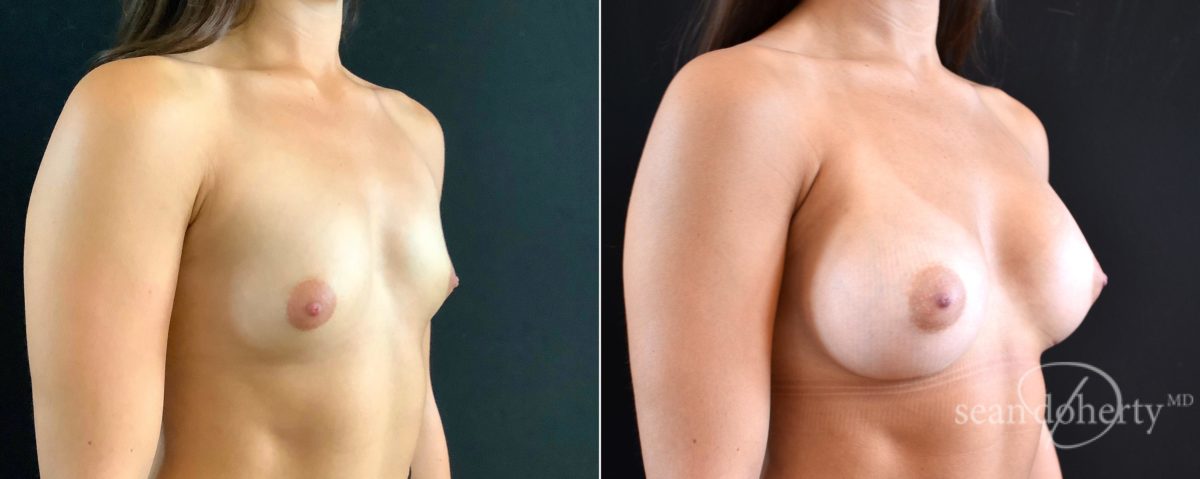 Patient 4670, Breast Augmentation Before and After Photos Breast Augmentation Before and After Photos in Boston, MA, Patient 4670