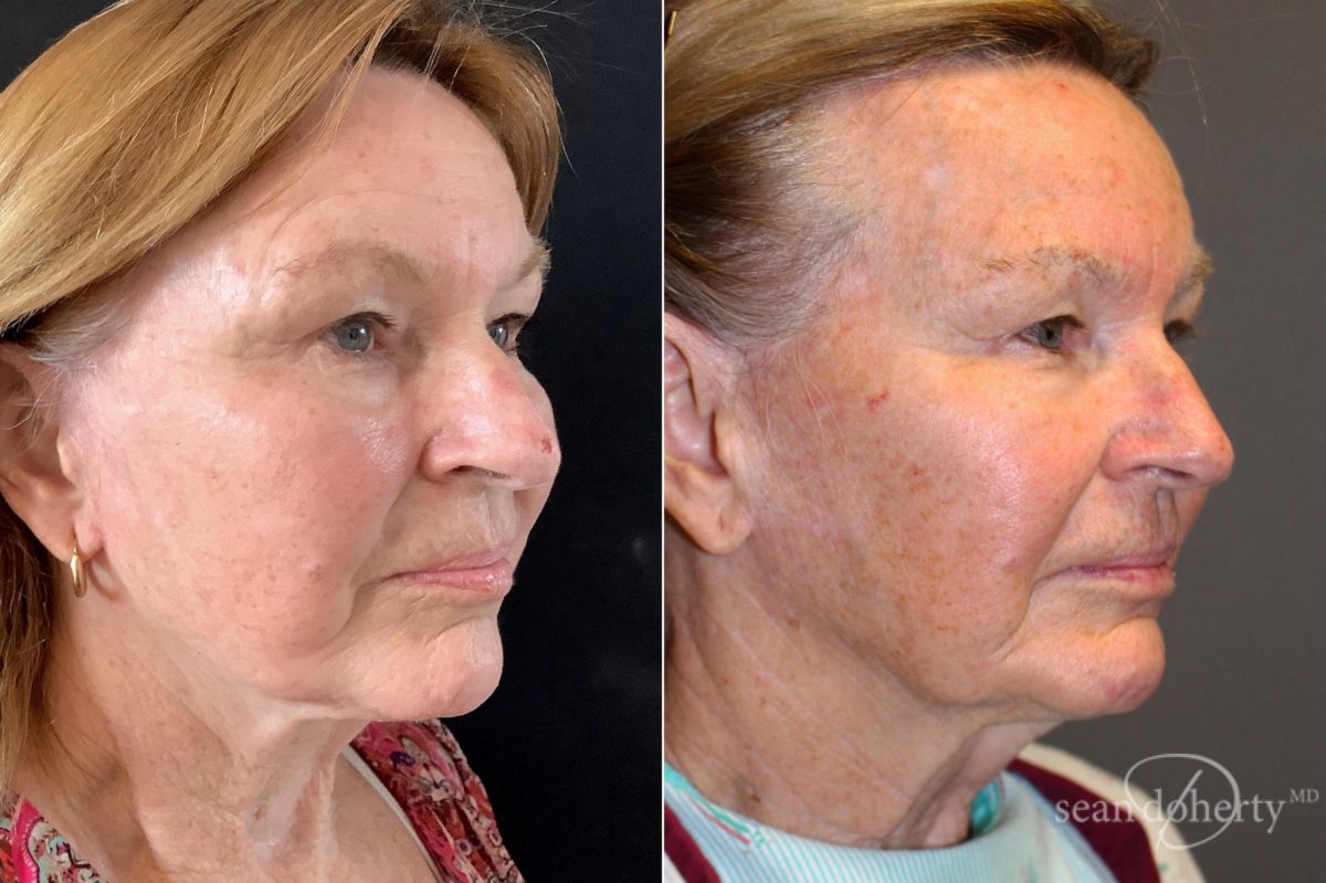 Patient 5087, Facelift Before and After Photos Facelift Before and After Photos in Boston, MA, Patient 5087