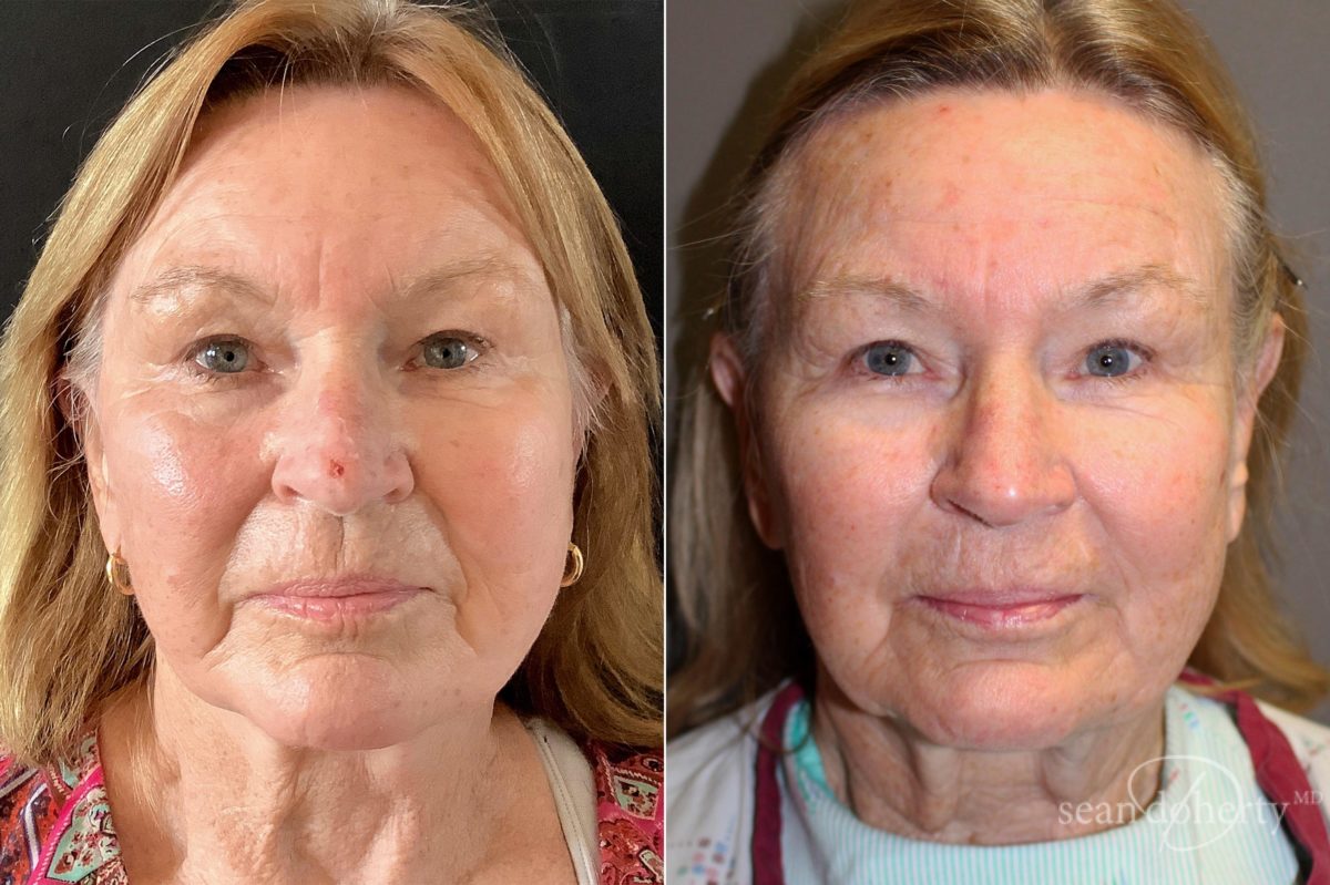 Patient 5087, Facelift Before and After Photos Facelift Before and After Photos in Boston, MA, Patient 5087
