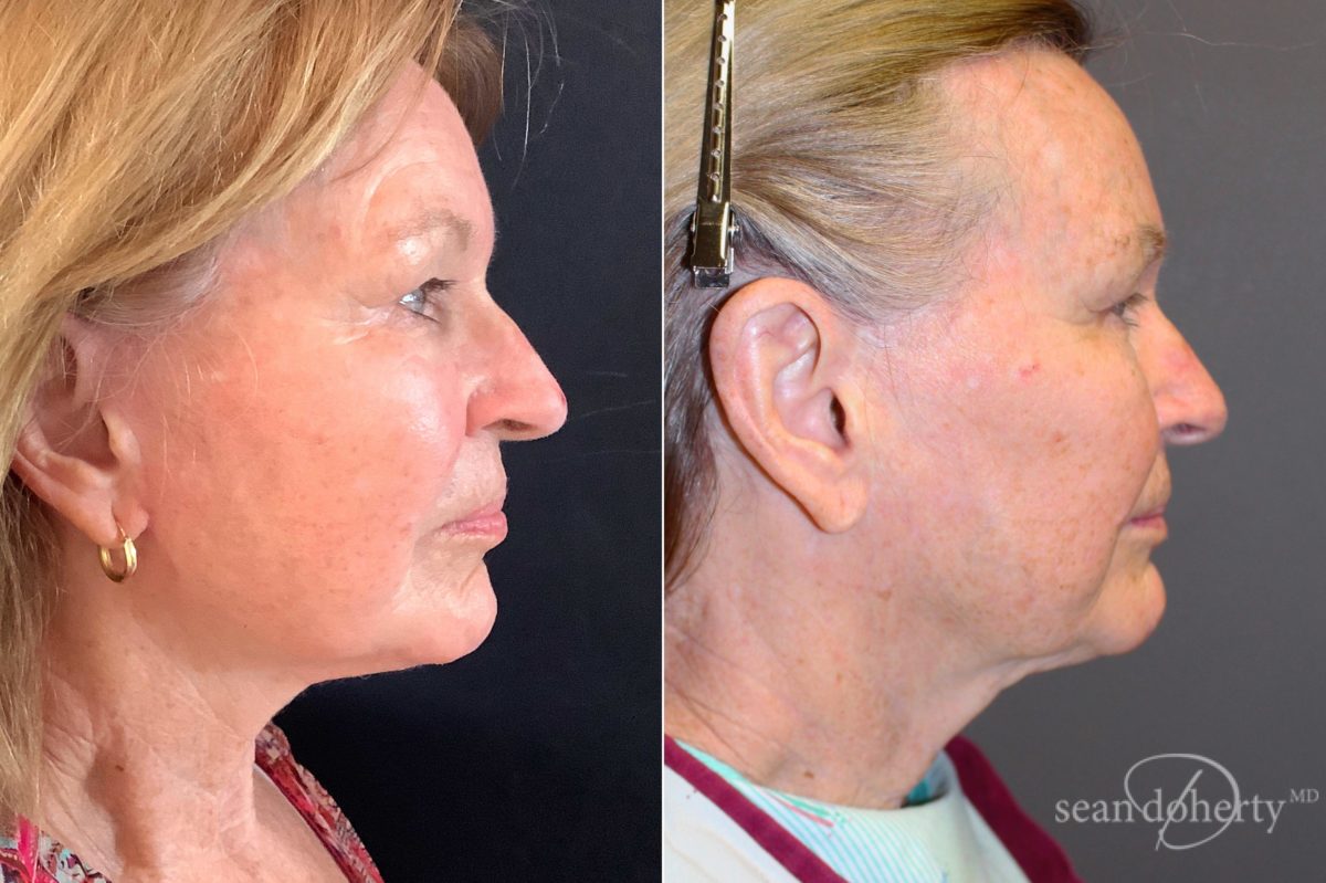 Patient 5087, Facelift Before and After Photos Facelift Before and After Photos in Boston, MA, Patient 5087