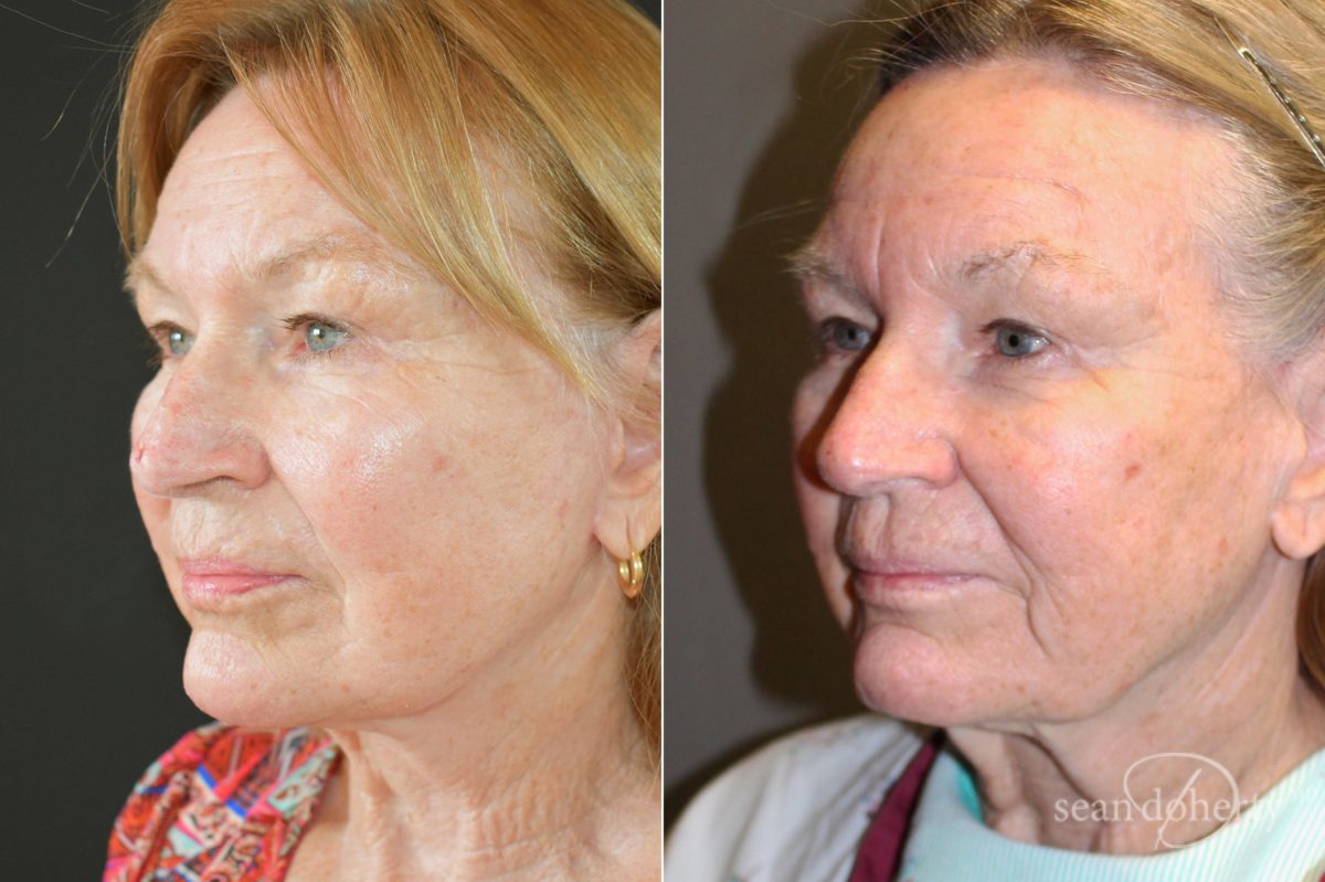 Patient 5087, Facelift Before and After Photos Facelift Before and After Photos in Boston, MA, Patient 5087